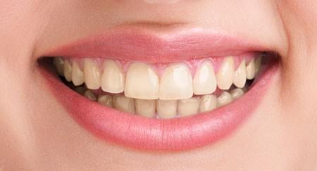 After Teeth Whitening